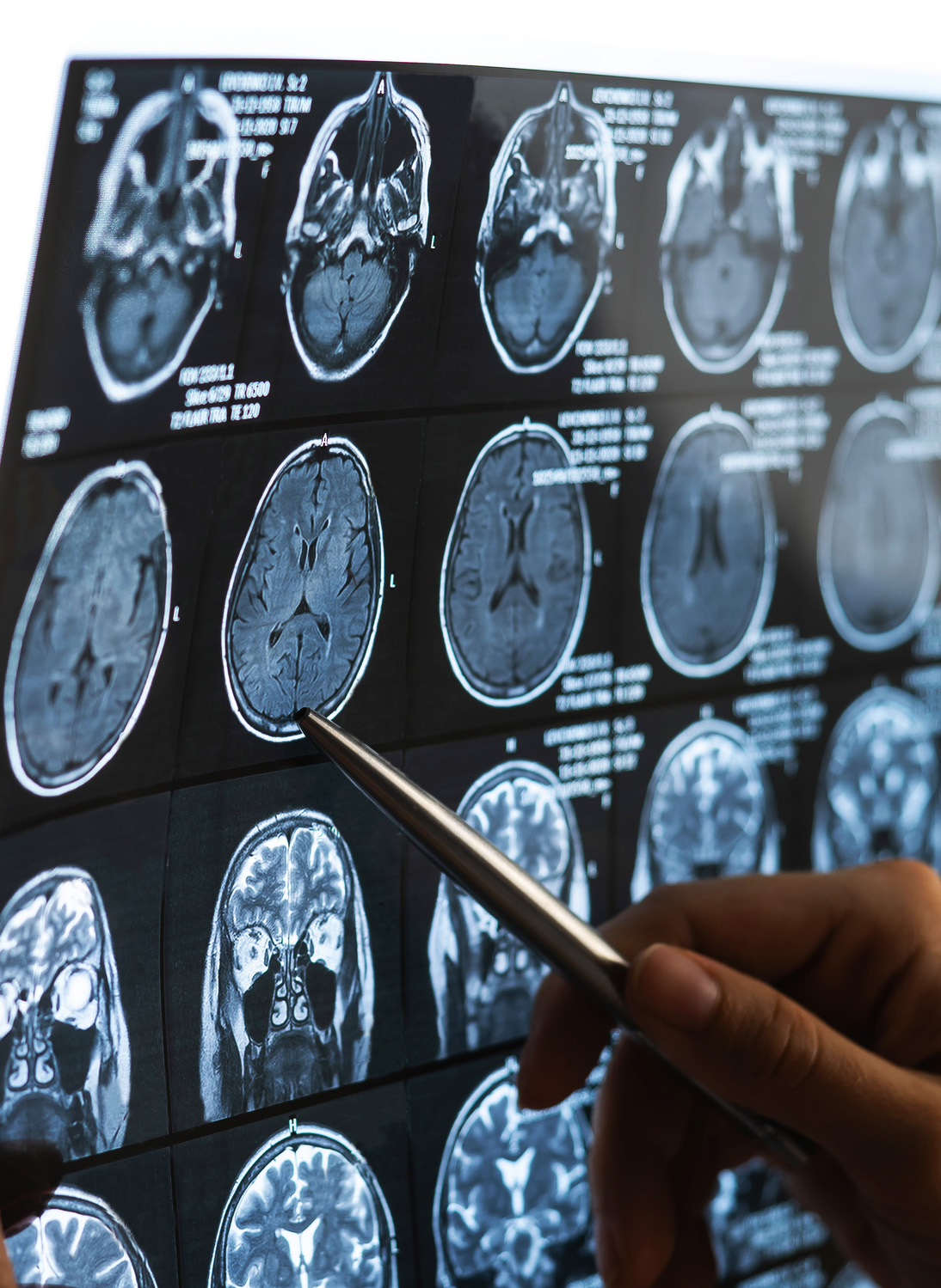 Pen pointing at a neurology brain scan.